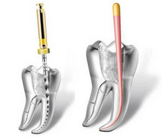 endodontic treatment